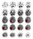 MRI brain show Brain tumor at right parietal lobe Royalty Free Stock Photo