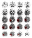 MRI brain show Brain tumor at right parietal lobe