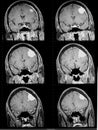 Mri of brain showing brain tumor