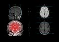 MRI brain showing coronal plane of the brain