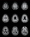 Mri of brain showing multiple sclerosis Royalty Free Stock Photo