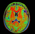 Mri brain stroke Royalty Free Stock Photo