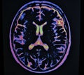 Mri brain stroke