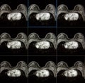 MRI of breast - breast cancer Royalty Free Stock Photo