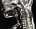 MRI C-spine a female 67 year old