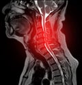 MRI of C-spine or magnetic resonance image of cervical spine sagittal T2 FS view for diagnosis spondylosis causing cervical