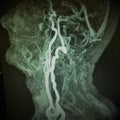 Mri carotid artery complete occlusion