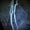 Mri carotid artery complete occlusion