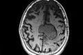 MRI image of cerebral lesion located in the middle line parietal -frontal area