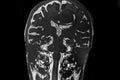 MRI image of cerebral lesion located in the middle line parietal -frontal area