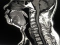 MRI Cervical spine