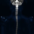 MRI of cervical spine use technique myelogram.