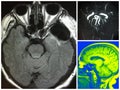 Mri clipping artifact bilateral cerebral aneurysm Royalty Free Stock Photo