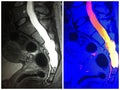 Mri dural ectasia sacrum level neuro collage Royalty Free Stock Photo