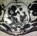 Fallopian tube neoplasm hematosalpinx pathology