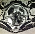 Fallopian tube neoplasm hematosalpinx pathology