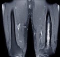 MRI Femur Impression : Chronic osteomyelitis Royalty Free Stock Photo