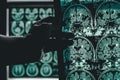 Dementia brain on MRI