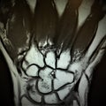 Mri fracture bones wrist exam