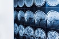 MRI of the head and brain of a person, tomography Royalty Free Stock Photo