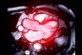 MRI heart or Cardiac MRI ( magnetic resonance imaging ) of heart 3 chamber view for diagnosis heart disease Royalty Free Stock Photo