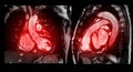 MRI heart or Cardiac MRI ( magnetic resonance imaging ) of heart compare RVOT and LVOT for diagnosis heart disease Royalty Free Stock Photo