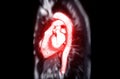 MRI heart or Cardiac MRI Royalty Free Stock Photo