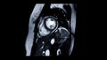 MRI heart or Cardiac MRI ( magnetic resonance imaging ) of heart. Royalty Free Stock Photo