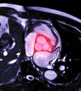 MRI heart or Cardiac MRI magnetic resonance imaging of heart showing aortic valve .