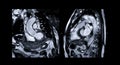 MRI heart or Cardiac MRI  magnetic resonance imaging  of heart compare RVOT and LVOT. Royalty Free Stock Photo