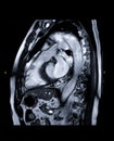 MRI heart or Cardiac MRI  magnetic resonance imaging  of heart  LVOT view . Royalty Free Stock Photo