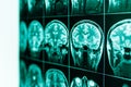 MRI of the human brain and brain in defocus