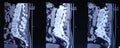 MRI image of the spine of a patient with scoliosis and protrusion of the intervertebral disc.