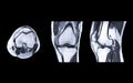 MRI Knee joint or Magnetic resonance imaging compare axial, coronal and sagittal view. Royalty Free Stock Photo