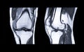 MRI Knee joint or Magnetic resonance imaging compare coronal and sagittal view .