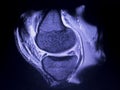 MRI knee meniscus tear scan