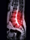 MRI L-S spine or lambar spine sagittal T2 technique for diagnosis spinal cord compression