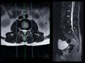 MRI L-S spine or lumbar spine Axial T2W view with sagittal plane for diagnosis spinal cord compression