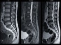MRI L-S spine or lumbar spine Sagittall T1W ,T2 FS and T2W view for diagnosis spinal cord compression