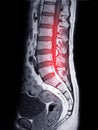 MRI L-S spine or lumbar spine Sagittall T1W view for diagnosis spinal cord compression