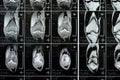 MRI of left knee joint showing minimal joint effusion, PHMM Posterior Horn Medial Meniscus degeneration, ACL anterior cruciate