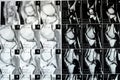 MRI of left knee joint showing minimal joint effusion, PHMM Posterior Horn Medial Meniscus degeneration, ACL anterior cruciate