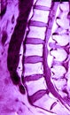 MRI of lumbar spine Royalty Free Stock Photo