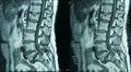 MRI Lumbar Spine