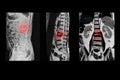 MRI of lumbar spine History of fall with back pain, radiate to leg, rule out spinal stenosis Royalty Free Stock Photo