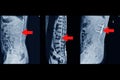 MRI of lumbar spine History of fall with back pain, radiate to leg, rule out spinal stenosis .Impression:Burst fracture of L2 Royalty Free Stock Photo