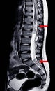 MRI Lumbar spine IMPRESSION:Intra-dural extramedullary mass at distal cord and conus medullaris, with tumor seedings at lower spin