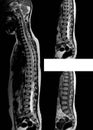 MRI Lumbar spine 3 views medical image.