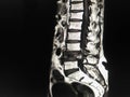 MRI Lumbar spine Collapsed fracture of L4 vertebral body with hypersignal T2 and increase enhancement, pathologic fracture should Royalty Free Stock Photo