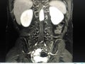 MRI Lumbar spine Royalty Free Stock Photo